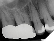 Maxillary 1st molar with severe canal calcification and independent MB2 canal. Only one R25B was used in all of the canals of the 1st maxillary molar, including the MB2 canal. R25B is shown in the MB2 canal. Each canal was instrumented with R25B without any prior instrumentation, without initial negotiation and without glide path. Another R25B was used to manage the calcified canals in the 2nd maxillary molar, also without any prior instrumentation.