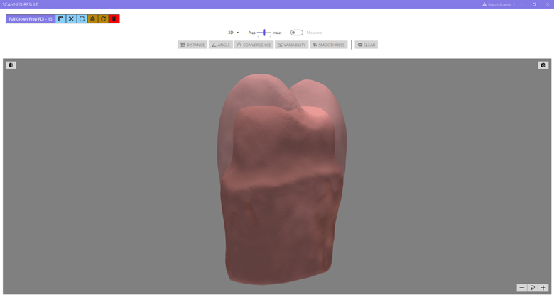 3D Crown Prep: A 3D illustration of intact Tooth #4 (ADA) [#15 (FDI)] superimposed on the crown-prepped tooth.