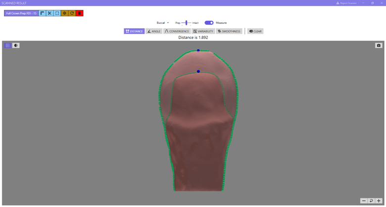 Mesial View – Isthmus Reduction: Mesial view showing intact Tooth #4 (ADA) [#15 (FDI)] superimposed on the crown-prepped tooth; the isthmus reduction measures 0.949 mm. 