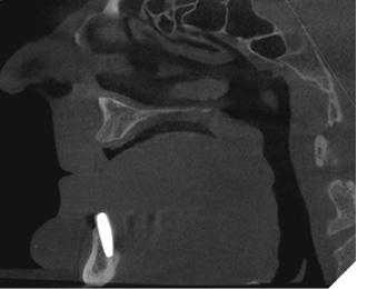 Select sagittal view of a CT facial bones demonstrating mandibular dental implant placement with the apex positioned along the lingual cortex and a significant lingual dehiscence.