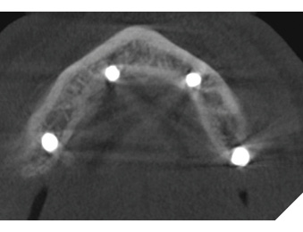 Select axial view of a CT facial bones showing four mandibular dental implants with loss of lingual cortex at the anterior right implant.
