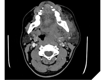 Select axial soft tissue view of the CT neck with contrast at the level of the mandible. Significant airway deviation and narrowing has occurred due to an expanding parapharyngeal hematoma arising from extraction site 38.
