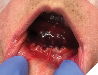Floor of mouth hematoma after persistent bleeding from a branch of the lingual artery.