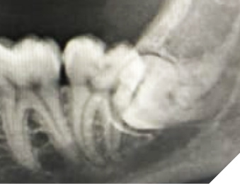 Select axial soft tissue view of the CT neck with contrast at the level of the mandible. Significant airway deviation and narrowing has occurred due to an expanding parapharyngeal hematoma arising from extraction site 38.
