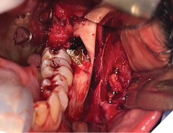 Intra-operative photograph of the left posterior mandible with vascular clips applied to the left facial artery.