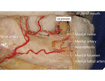 Dissection of the right facial artery in a latex-injected cadaver demonstrating the close proximity of the facial artery to the third molar region. Source: Iwanaga, J., Shiromoto, K. & Tubbs, R. S. Releasing incisions of the buccal periosteum adjacent to the lower molar teeth can injure the facial artery: an anatomical study. Surgical and Radiologic Anatomy 42, 31–34 (2020).