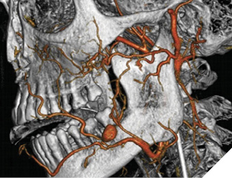 Three-dimensional angiogram demonstrating a pseudoaneurysm just distal to the left facial artery following third molar removal. Source: Pukenas, B. A., Albuquerque, F. C., Pukenas, M. J., Hurst, R. & Stiefel, M. F. Novel endovascular treatment of enlarging facial artery pseudoaneurysm resulting from molar extraction: A case report. Journal of Oral and Maxillofacial Surgery 70, (2012).