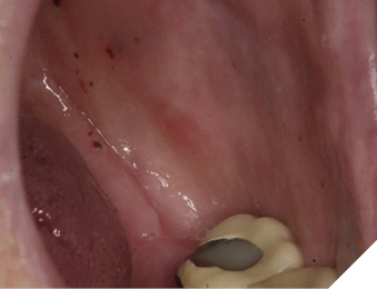 Mucosal petechiae of the left posterior buccal mucosa in a patient with liver disease and thrombocytopenia. Source: Napeñas, J. J., Brennan, M. T. & Elad, S. Oral Manifestations of Systemic Diseases. Dermatol Clin 38, 495–505 (2020).