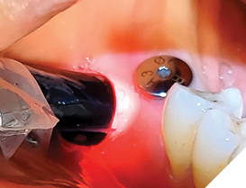 Use of photobiomodulation to help manage inflammation and promote healing around a lower first-molar implant.