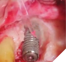 The Er:YAG laser, at appropriate settings, removes granulomatous and diseased soft tissue from the implant surface and surrounding areas without heating or damaging the implant surface.