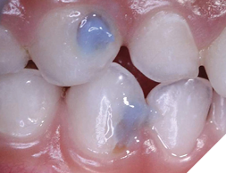 Prophy, and apply one drop of Papacárie Duo. Allow to remain in place for 30-60 seconds.