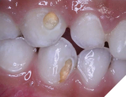 Excavate the demineralized dentin without drilling or anesthetic, relieving the patient of dental anxiety, leaving a hard, shiny, restorable surface.
