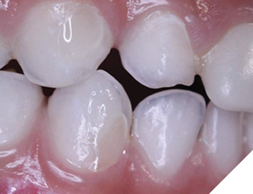 Restore the cavities.