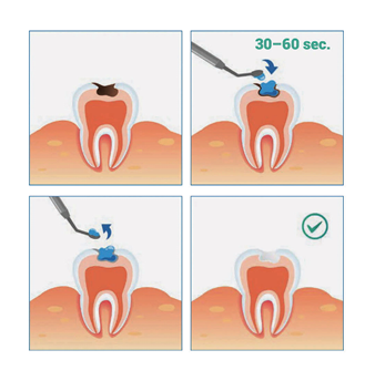 3A. Access to the cavity (top left); 3b. Apply Papacárie Duo to the decayed tissue, and allow it to work for 30-60 seconds (top right); 3c. Remove softened carious dentin with a curette. For extensive decay, repeat the procedure (bottom left); 3d. Once the surface is shiny and hard, decontaminate and restore (bottom right).