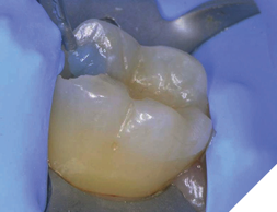 Apply a single drop of Papacárie Duo to the carious tissue.