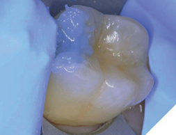 Allow Papacárie Duo to remain in place in the cavity for 30-60 seconds. It selectively removes only infected tissue, helping to preserve dentin that has the potential for remineralization.