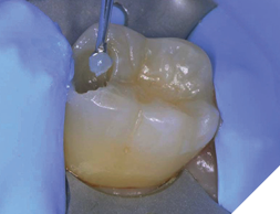 Remove infected dentin by scraping the surface and gently scooping out damaged dentin.