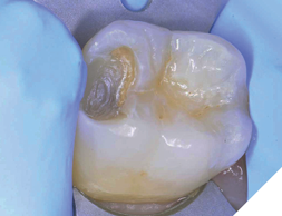 Observe hard and shiny surface. No signs of softened dentin or dentin shavings. Decontaminate and restore.