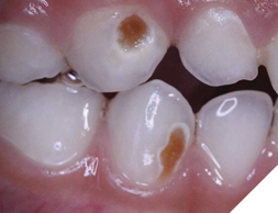 Identify caries and prepare access.