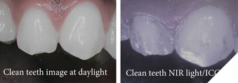Left: Teeth just after effective brushing (in natural light). Right: Teeth after rinsing with Lumorinse (in near-infrared imaging)Lumorinse, a green, photosensitive mouthwash, attaches to plaque bacteria, indicating that even excellent toothbrushing leaves significant residual plaque. The rinsed teeth will be treated with the Lumoral Light.