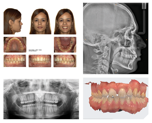 健康・医学 Aligner generation The Rise of Clear Aligners in Orthodontic Treatment