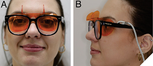 Example of behind-the-glasses, Ease in Shields (Ultradent, South Jordan, UT, USA). The subject is one of the authors, CM.