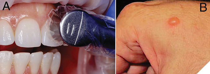 Unless used carefully, curing lights with large tip diameters will irradiate the gingiva (A) and may burn the soft tissues. (B) A tissue burn on the back of the hand caused by a high-power LCU.