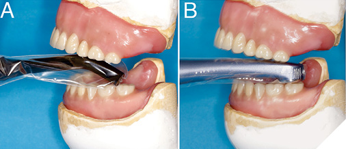 A poorly designed light guide (A) limits access to the posterior molars, whereas a low-profile head (B) allows better access.