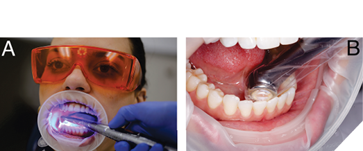 Low-profile heads, such as from the Woodpecker X-Star, can access the lingual of mandibular posterior and the anterior teeth. (CM is the subject in the image)