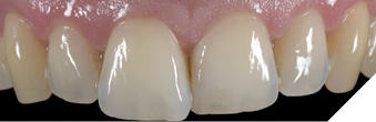 Pre-op situation: Misaligned central incisors.