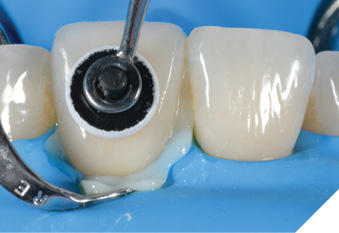 Flowable consistency when placing the veneer on the tooth.