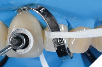 Removal of excess material immediately after placement and 2-second tack cure.