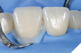 Covering
the cementation joint with glycerine gel.
