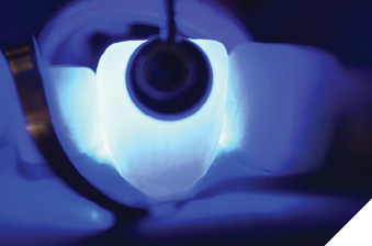 Final light curing.