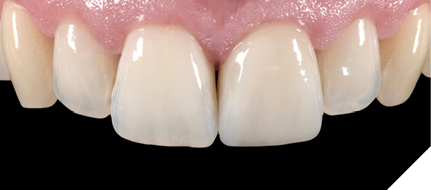 Ten days
after the placement of the veneer: a natural-looking beautiful result.