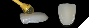 Veneer for tooth 21, made from IPS e.max Press HT.