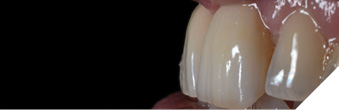 Trying in the veneer using Variolink Esthetic Try-In paste.