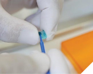 Conditioning the veneer with ceramic primer (Monobond Etch & Prime): rub into the surface for 20 seconds, allow to react for another 40 seconds, rinse off thoroughly.