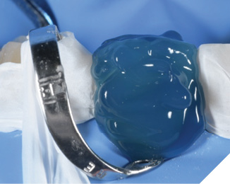 Etching the tooth surface with phosphoric acid: allow to react for 30 seconds, rinse with water for 40 seconds.