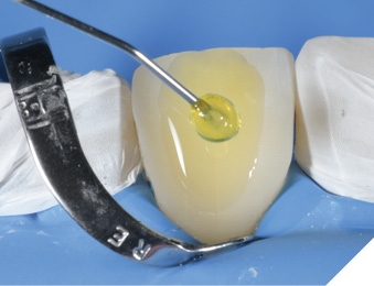 Applying the adhesive (Adhese Universal) using the VivaPen.