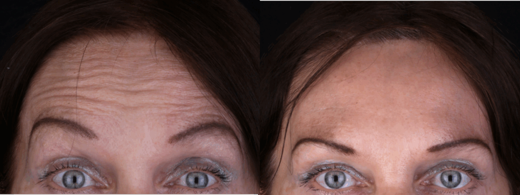 Figure 2. The gold standard for using botulinum toxin is the upper third of the face.