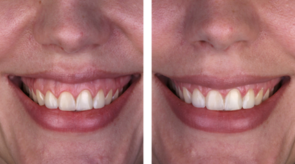 The result of botulinum toxin therapy to correct a gummy smile