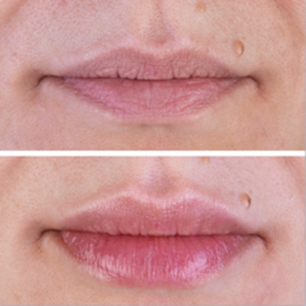 Anti-age effect of lip augmentation.