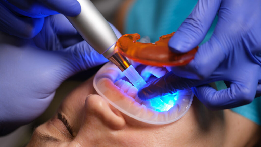 Dentist curing adhesive resin with blue light during a dental restoration procedure, representing new antibacterial dental adhesive technology to extend filling lifespan.