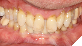 Patient with generalized abrasion lesions on the cervical third of maxillary teeth