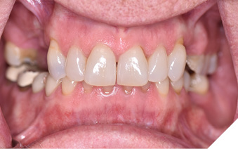 Maximum intercuspation. 