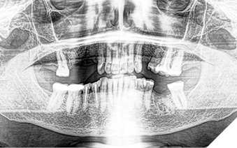 Pre-operative panoramic radiograph.