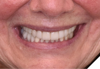 Post-operative smile.