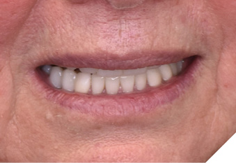  Post-operative teeth at rest