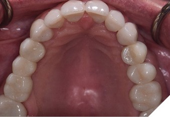 Maxillary occlusal view, post-treatment. 